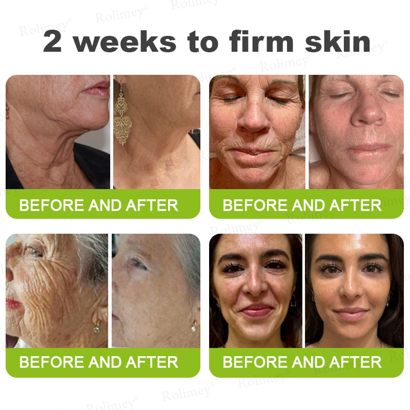 🇬🇧Made and shipped from the UK👉Rolimey® Botox & Vita-A Retinol Shot Wrinkle-Lift Tightening cream - Last Day Promotion 70% OFF