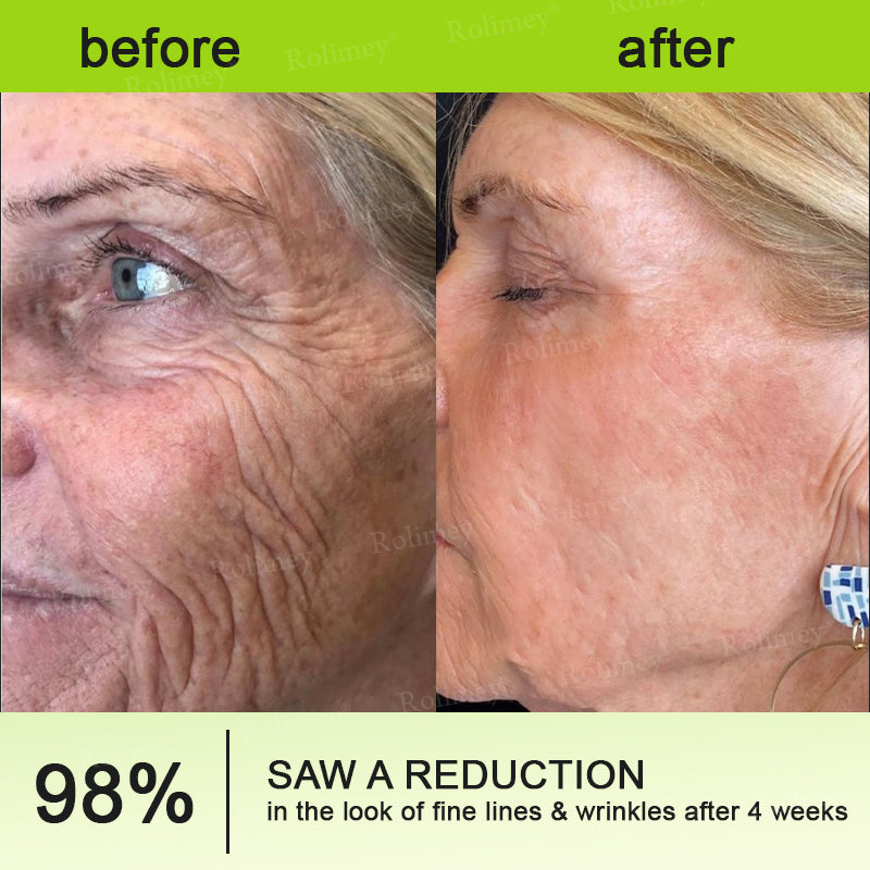 🇬🇧Made and shipped from the UK👉Rolimey® Botox & Vita-A Retinol Shot Wrinkle-Lift Tightening cream - Last Day Promotion 70% OFF