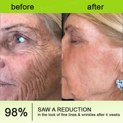 🇬🇧Made and shipped from the UK👉Rolimey® Botox & Vita-A Retinol Shot Wrinkle-Lift Tightening cream - Last Day Promotion 70% OFF