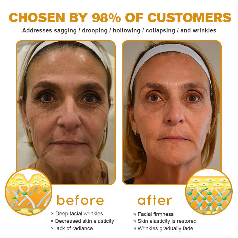 🌲👩‍⚕️(🐝Made and Shipped from UK✅) Furzero™ Botox Bee Venom Wrinkle Removal Cream- LAST DAY 70% OFF