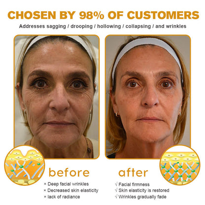 🌲👩‍⚕️(🐝Made and Shipped from UK✅) Furzero™ Botox Bee Venom Wrinkle Removal Cream- LAST DAY 70% OFF
